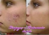 tratamento de acne produtos da adcos