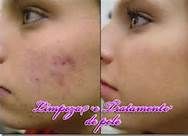 tratamento de acne produtos da adcos